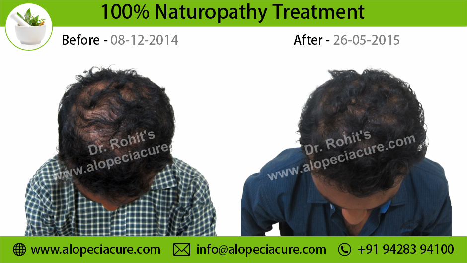 male hair loss treatment